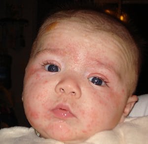 Ekcémás babák anyukái, babátok mikorra nőtte ki ezt a börbetegséget?